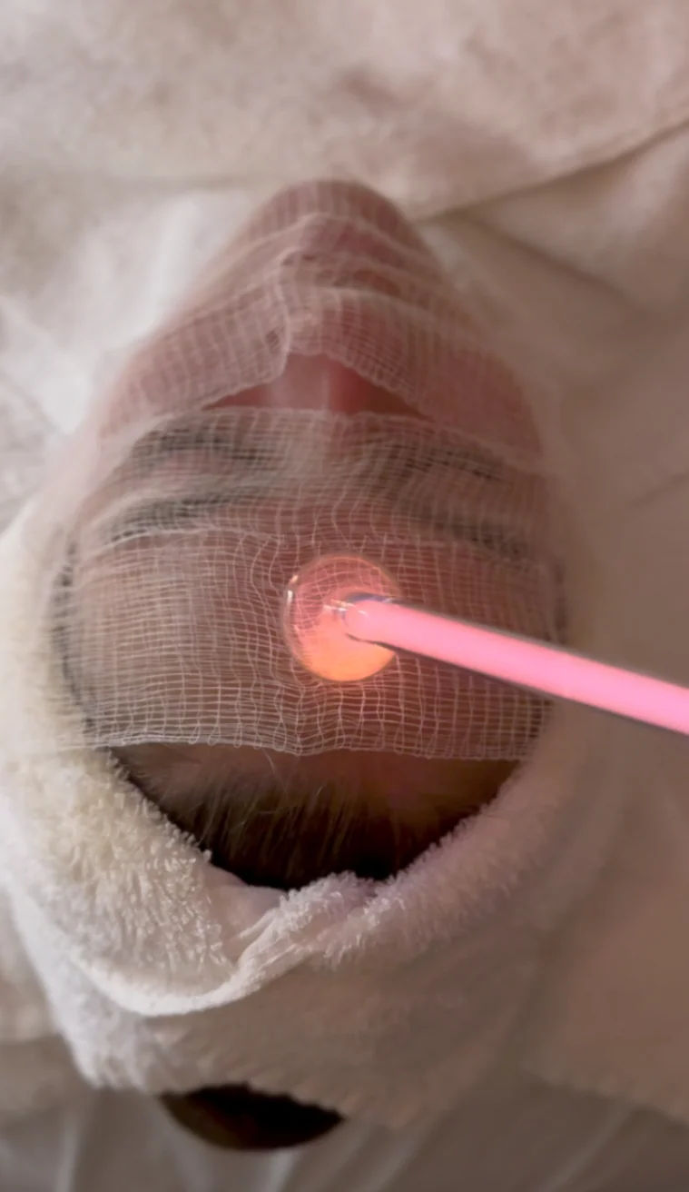 A glowing high frequency glass electrode held over gauze on a client's face